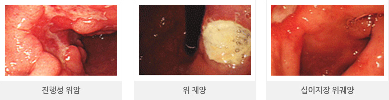 진행성 위암, 위 궤양, 십이지장 위궤양