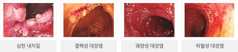 심한 내치질, 결핵성 대장염, 궤양성 대장염, 허혈성 대장염