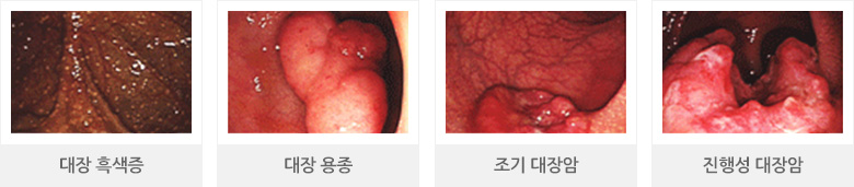 대장 흑색증, 대장 용종, 조기 대장암, 진행성 대장암